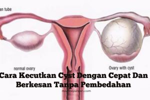 Cara Kecutkan Cyst Dengan Cepat Dan Berkesan Tanpa Pembedahan