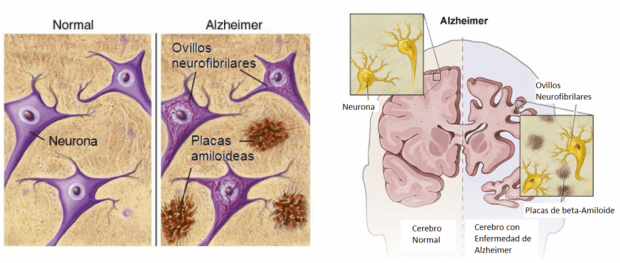 Adakah Rawatan Untuk Alzheimer Bagi Mereka Yang Sudah Berusia?