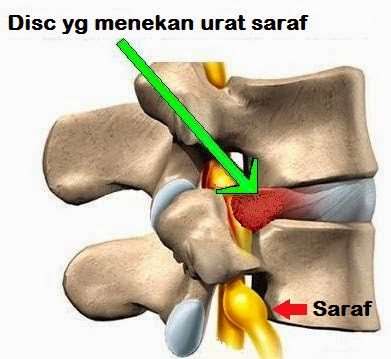Rawatan Slip Disc Untuk Kurangkan Sakit Pada Tulang Belakang